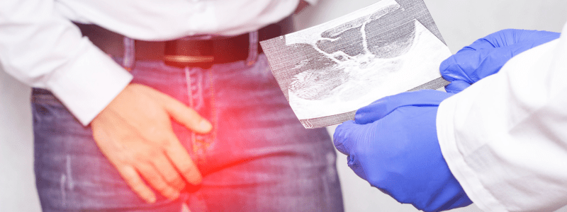 Testes Scrotum Ultrasound   Ultrasound Plus